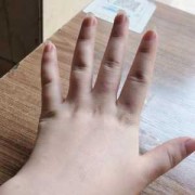 怀孕期手肿（孕31周，手肿怎么办）