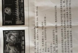 胎儿u型压迹（胎儿u型压迹是什么意思）
