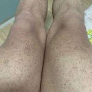 给鸡吃了感冒药.鸡生的蛋孕妇能吃吗,孕期鸡皮肤更严重了
