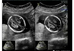 胎儿右侧脉络丛囊肿是什么意思（17周胎儿右侧脉络丛囊肿是什么意思）
