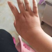 怀孕期手肿（孕31周，手肿怎么办）