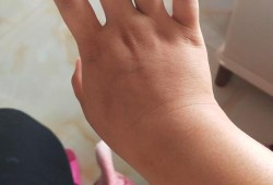 怀孕期手肿（孕31周，手肿怎么办）