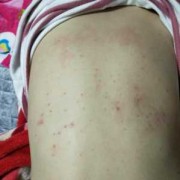 孕期一直长痘痘怎么办（怀孕后背上长了好多痘痘怎么办）