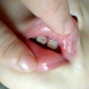 牙齿变小，怎么回事请给解答原因,胎儿变小了怎么回事