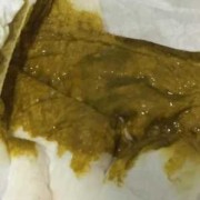 胎儿油症（为什么宝宝大便会油油的）