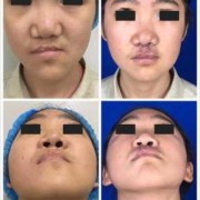 胎儿兔唇是什么原因造成的（兔唇修复手术要多少钱）