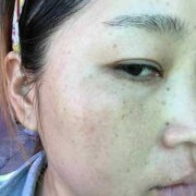 孕期妊辰斑（孕期妊辰斑怎么去掉）