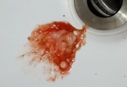 怀孕期间有出血怎么办（孕妇孕吐吐出血怎么办）