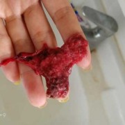 孕期出血有血块（孕期出血有血块孩子能保住吗）