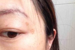 孕期长斑点（孕期长斑点是怎么回事）
