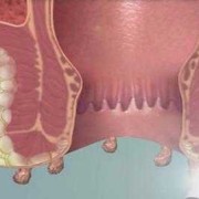 孕期肛门痒（怀孕6个月，肛门瘙痒疼痛怎么回事）