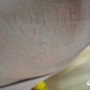 孕期肚皮干燥起皮图片（孕期肚皮干燥起皮图片大全）