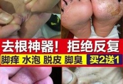 孕期治疗脚气（孕期治疗脚气的药会导致胎儿畸形吗?）