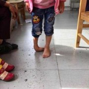 婴儿出生时双脚掌内翻可以效正吗,胎儿双足内翻能治好吗