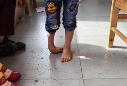 婴儿出生时双脚掌内翻可以效正吗,胎儿双足内翻能治好吗