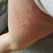 孕期皮肤痒（为什么怀孕后身上老是痒痒呢？晚上的时候特别痒，好难受）