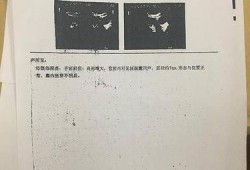 b超mi是什么意思,胎儿b超指数参考