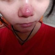酒糟鼻孕期（孕妇酒糟鼻）