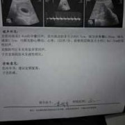子宫肌瘤超三厘米能怀孕生孩子吗,子宫肌瘤多大影响胎儿发育