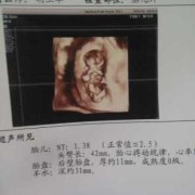 孕期nt是检查胎儿什么,NT是胎儿的什么
