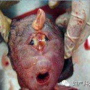胎儿继发隔（胎儿继发隔）