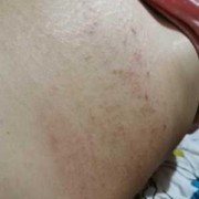 孕期肚子长湿疹怎么办（孕晚期大腿内侧长湿疹的很痒怎么治疗）