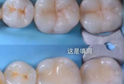 怀孕期间能不能补牙（怀孕期间能不能补牙洞）
