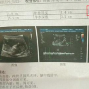 怀孕四十三天B超检查胎囊周围有液性暗区，该怎么办,孕期四周为一个月吗