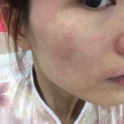 孕期面部皮炎（孕期面部皮炎）