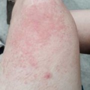 孕妇长湿疹怎么办,孕期湿疹加重怎么办啊