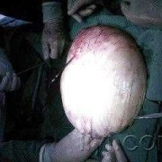 胎儿盆腔囊肿（胎儿盆腔囊肿）
