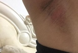 孕期腋下痒（孕期腋下痒怎么回事）