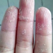 手指脱皮的原因及治疗方法,孕期手指掉皮脱皮是怎么回事