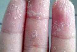 手指脱皮的原因及治疗方法,孕期手指掉皮脱皮是怎么回事