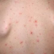 怎样让水痘不影响胎儿（宝宝长水痘，给宝宝怎样治疗好的快呢）
