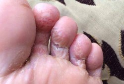 怀孕期间脚气（怀孕了脚气很痒怎么办，怀孕了脚气发作怎么办）