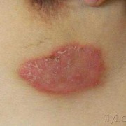 孕期乳晕长湿疹怎么办（孕期乳晕长湿疹怎么办啊）