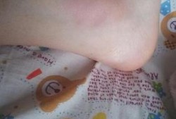孕期脚踝肿（孕晚期脚肿是怎么回事）