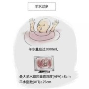 孕妇羊水多对胎儿有没有影响（羊水过多胎儿畸形风险多大）