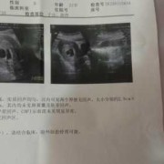 什么造成胎儿没有胎心（什么造成胎儿没有胎心胎芽）