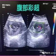 阴超对胎儿有什么危害（阴超对胎儿的危害）