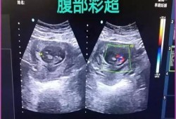 阴超对胎儿有什么危害（阴超对胎儿的危害）