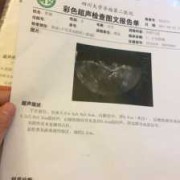 孕期查出子宫肌瘤（孕期查出子宫肌瘤要紧吗）