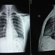 孕期做了胸透（不知道怀孕的情况公司体检做了X光胸透视对胎儿有影响吗）