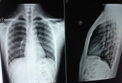 孕期做了胸透（不知道怀孕的情况公司体检做了X光胸透视对胎儿有影响吗）