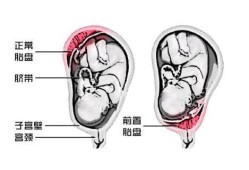 胎儿位于前壁（胎儿位于前壁和后壁有什么区别）