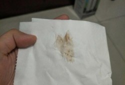 孕期白带发黑怎么回事