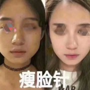 怀孕期间可以打瘦脸针吗（请问备孕期间可以打瘦脸针吗?有什么需要注意的呢）
