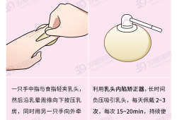 乳头内陷孕期怎么治疗（乳头内陷孕期怎么治疗好）