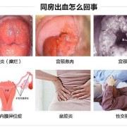 怀孕后宫颈息肉出血怎么办,孕期息肉出血对胎儿有影响吗